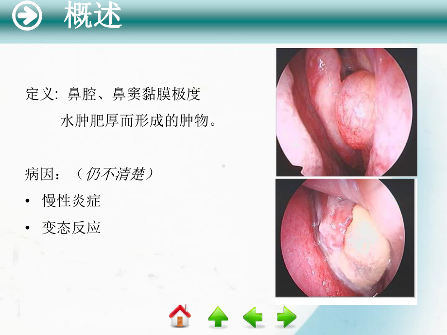 第六节 鼻息肉 .ppt_第2页