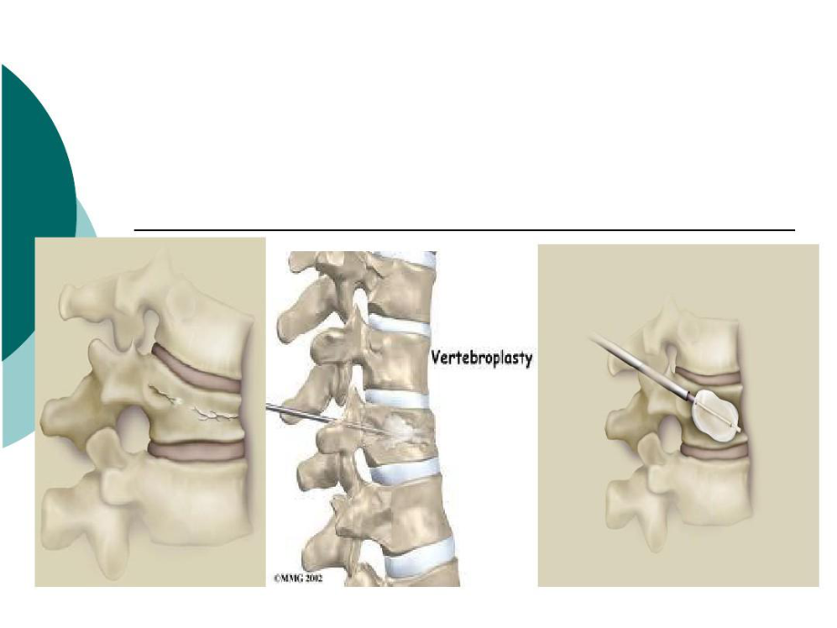 abc经皮椎体后凸成形术教学课件.ppt_第3页
