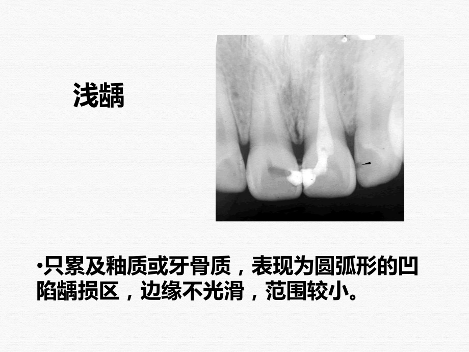 牙及牙周疾病影像学表现教学课件.pptx_第3页