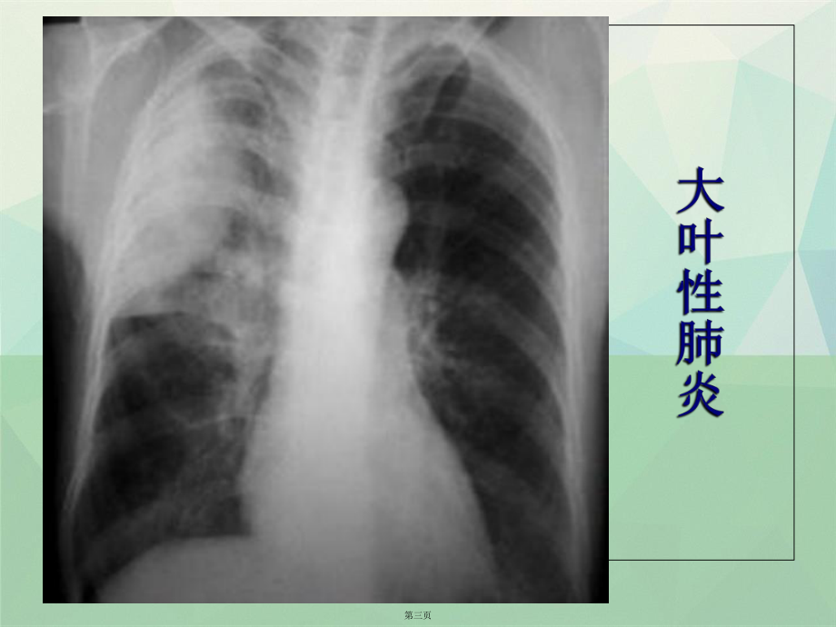 X线培训临床执业医师实践能考试讲课课件.ppt_第3页