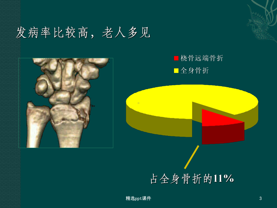 桡骨远端骨折课件79062.ppt_第3页