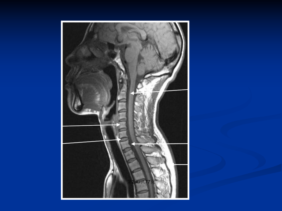 脊髓和椎管内疾病教案课件.pptx_第3页