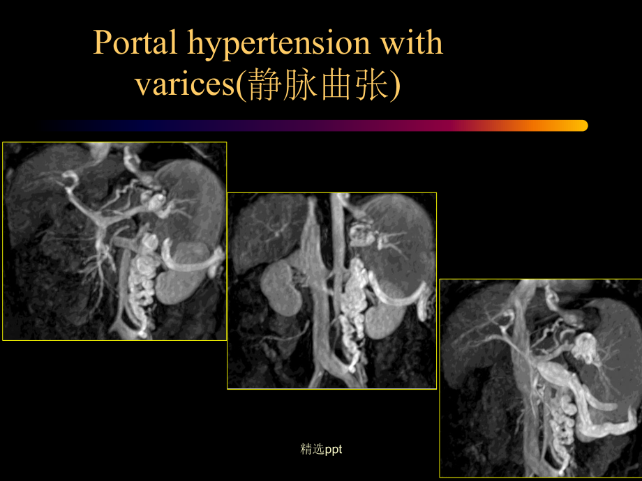 门静脉海绵样变课件.ppt_第3页