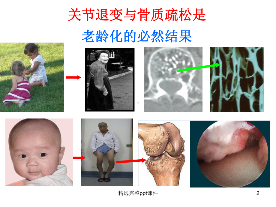 骨关节炎的阶梯治疗1课件.ppt_第2页