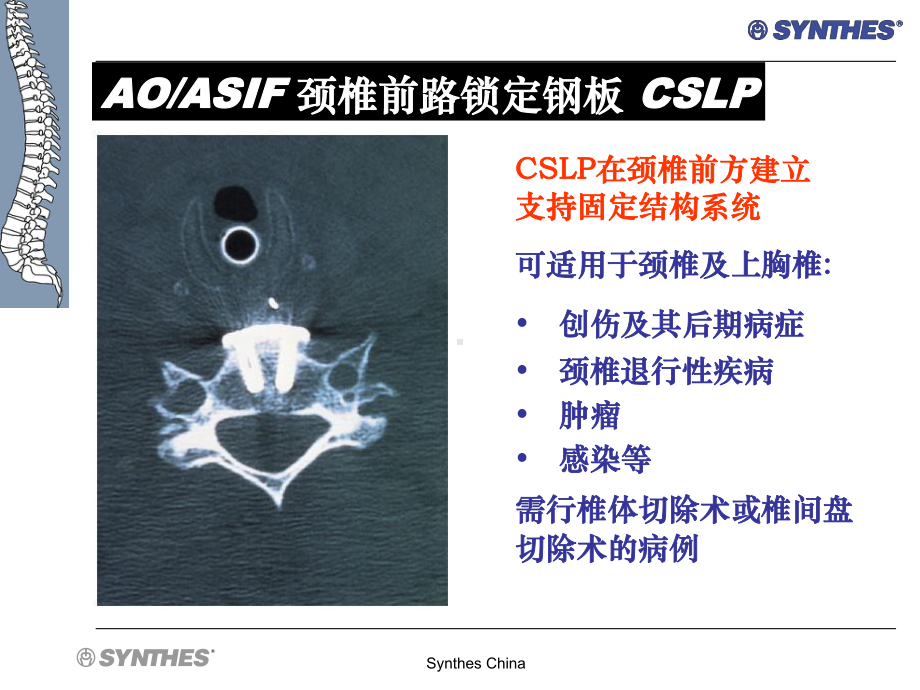 颈椎前路锁定钢板CSLP-NA-SS.ppt_第2页