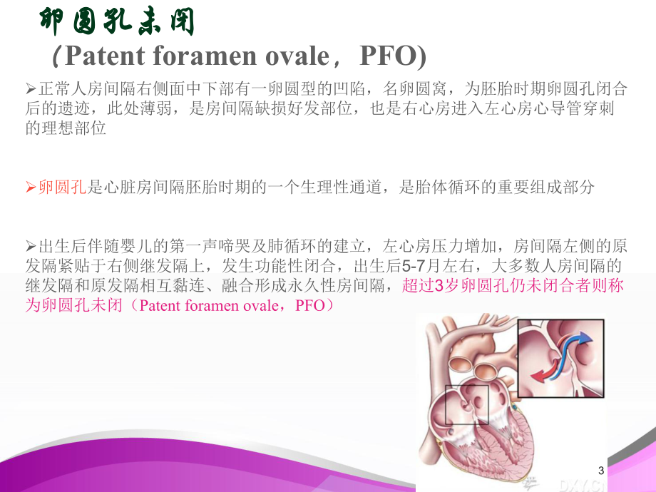 伴有卵圆孔未闭的隐源性卒中或TIA患者诊疗策略-课件.ppt_第3页