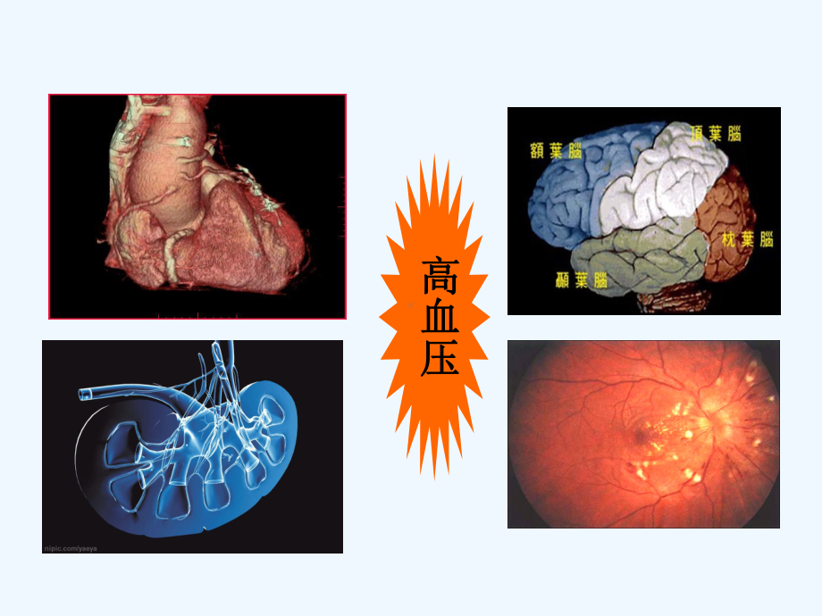 中医“治未病”健康宣教高血压[可修改版]课件.ppt_第3页