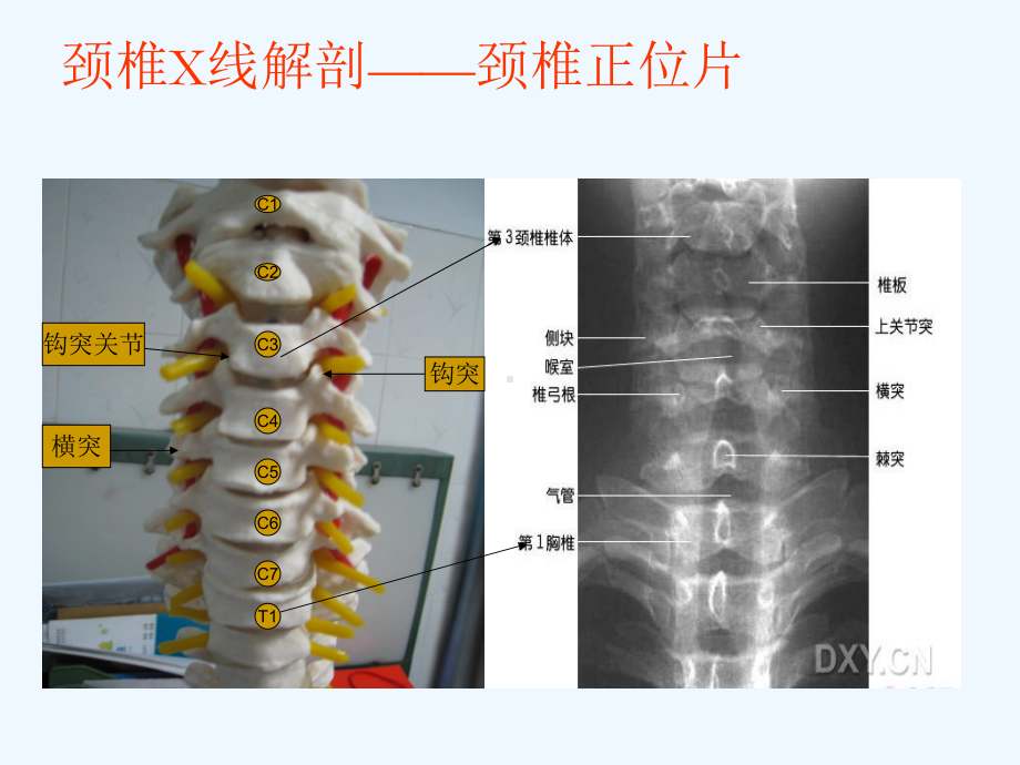 颈椎X线诊断判断椎体退变课件.ppt_第3页