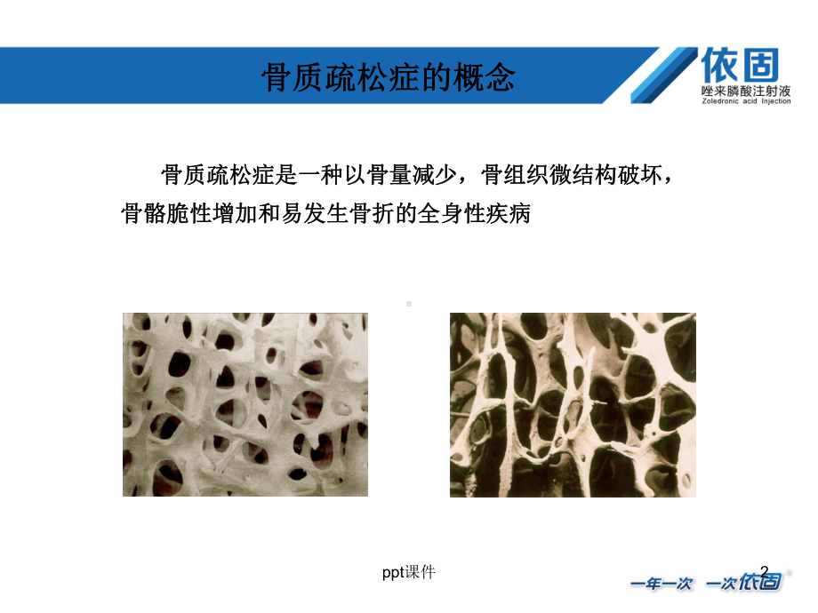 骨质疏松症及唑来膦酸的应用-课件.pptx_第2页