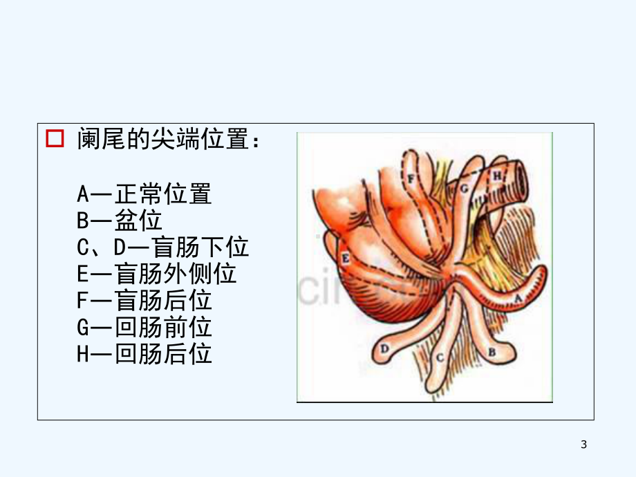 小讲课阑尾炎-课件(同名782).ppt_第3页