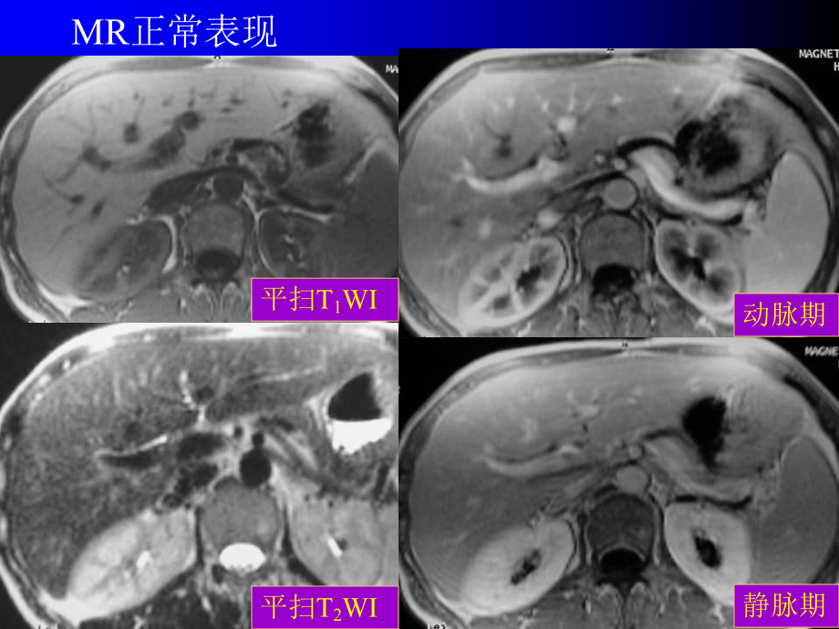 腹部的MRI诊疗培训课件.ppt_第3页