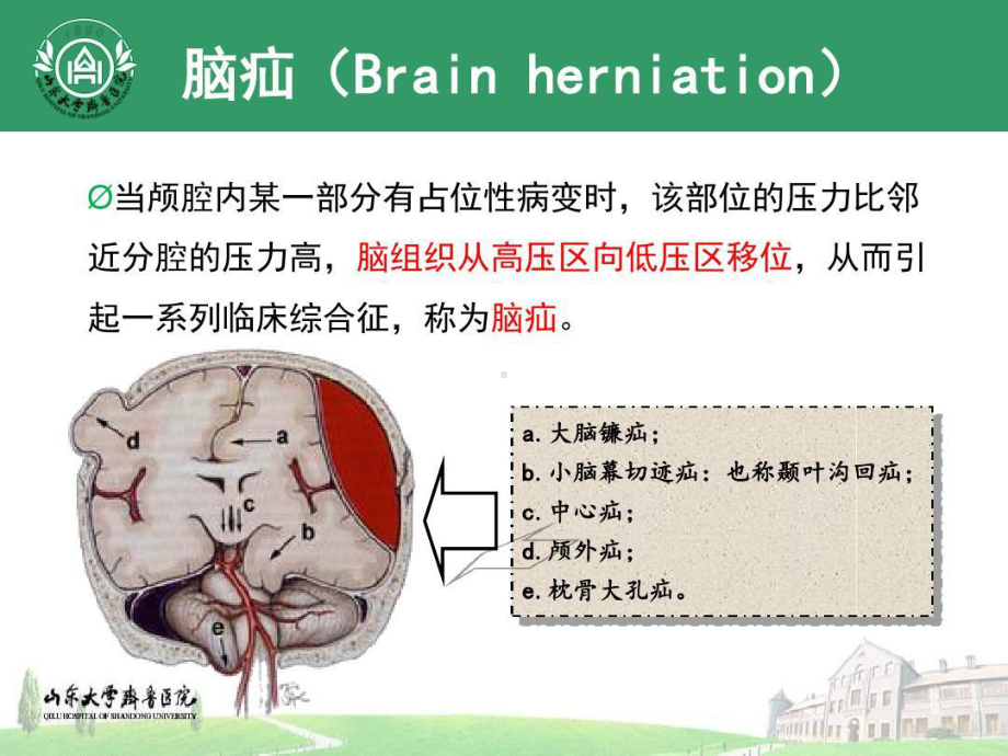 双侧小脑幕切迹疝病人救治共.ppt_第2页