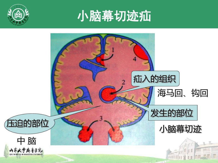 双侧小脑幕切迹疝病人救治共.ppt_第3页