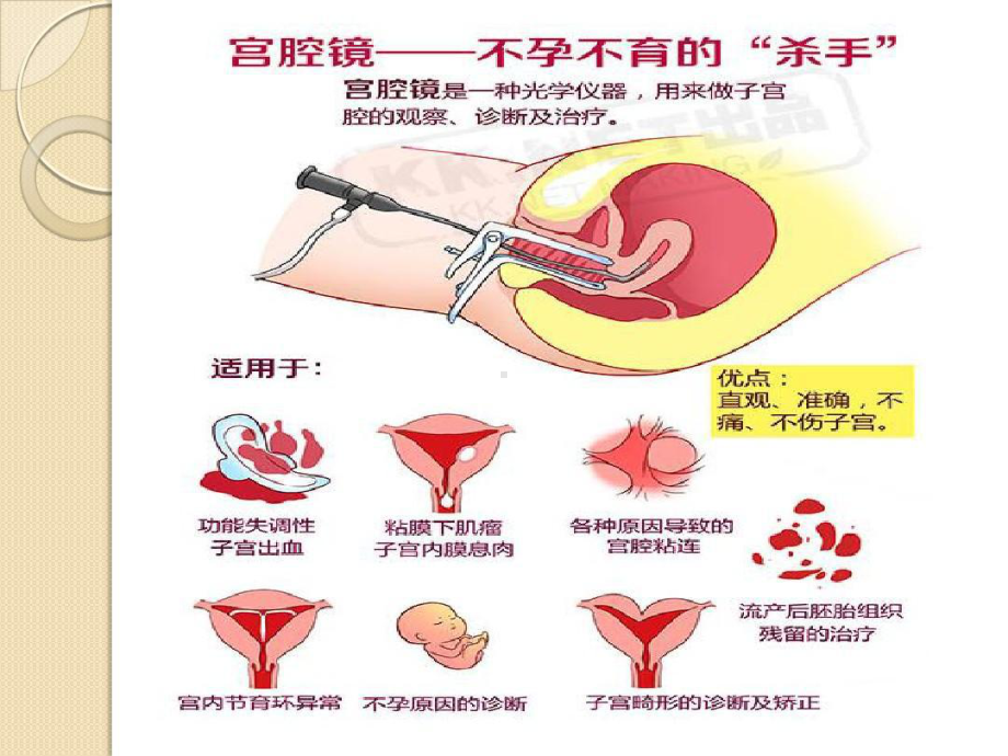 宫腔镜在妇科临床的应用-基础知识-北京妇产医院-段华.ppt_第3页