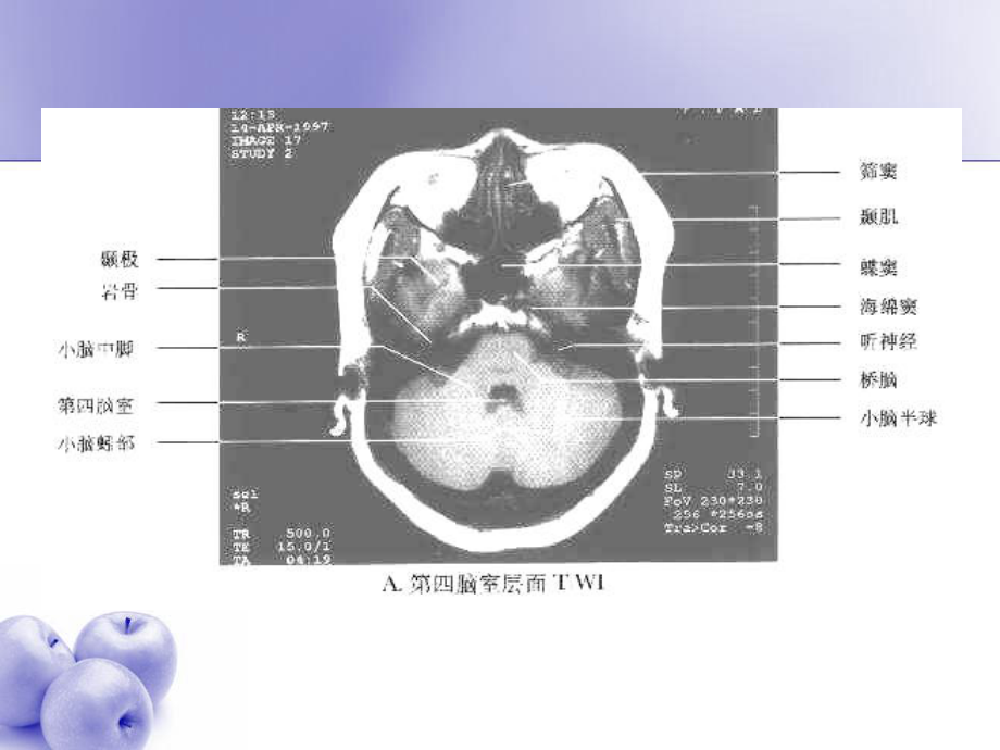 中枢神经系统常见肿瘤的MRI诊断-课件.ppt_第2页