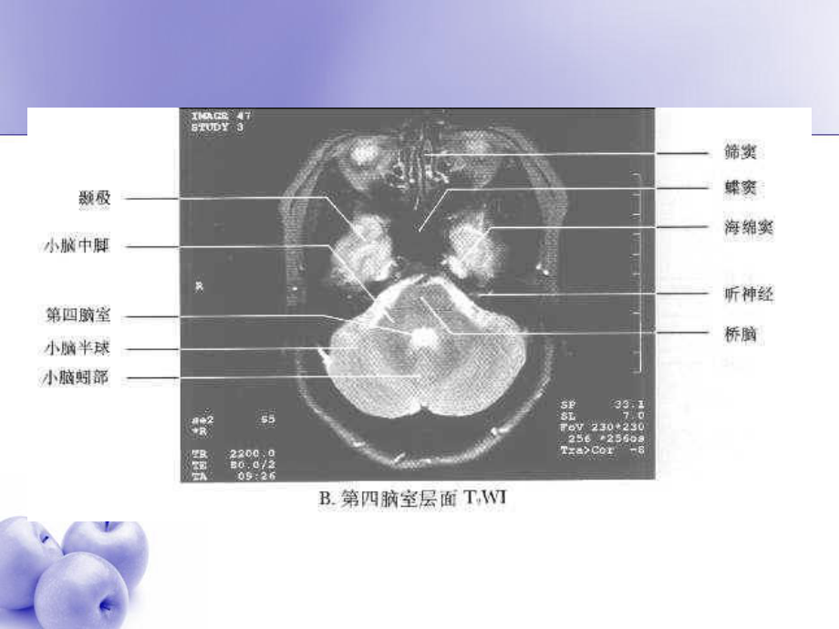 中枢神经系统常见肿瘤的MRI诊断-课件.ppt_第3页