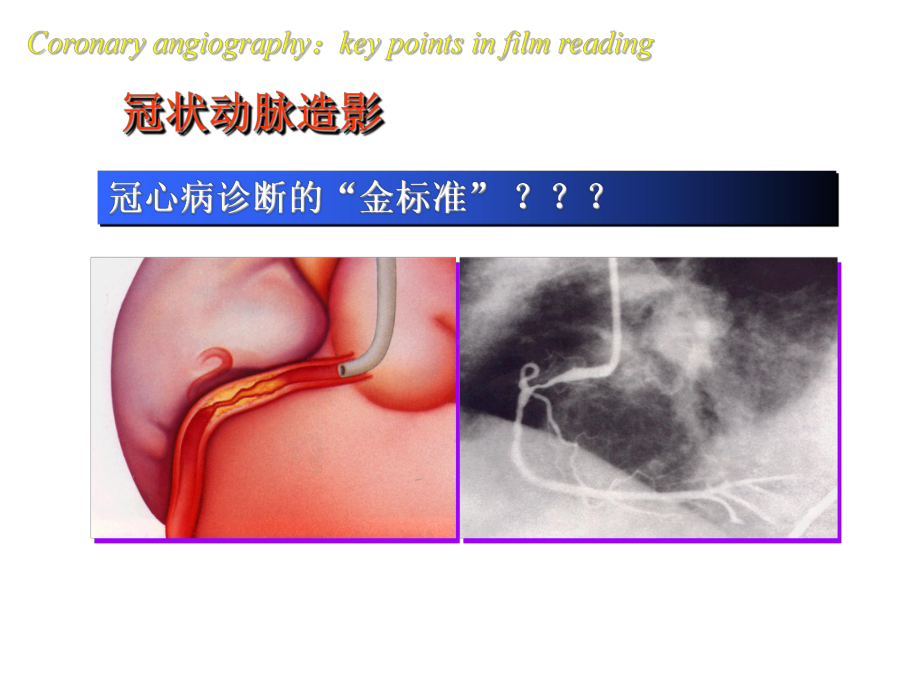 冠脉造影阅片要领课件.ppt_第2页