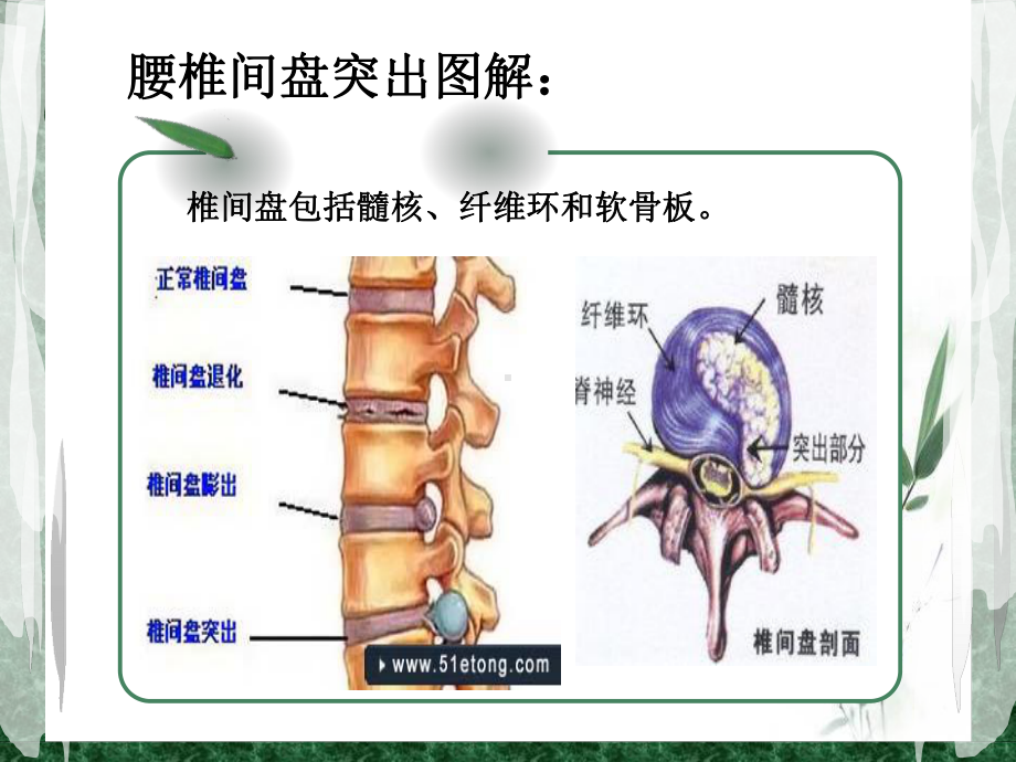 腰椎间盘突出教学课件.ppt_第3页