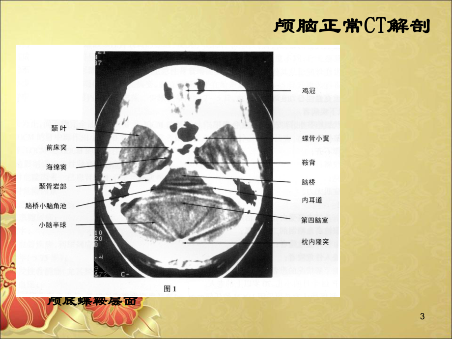 头部影像诊断学课件.ppt_第3页