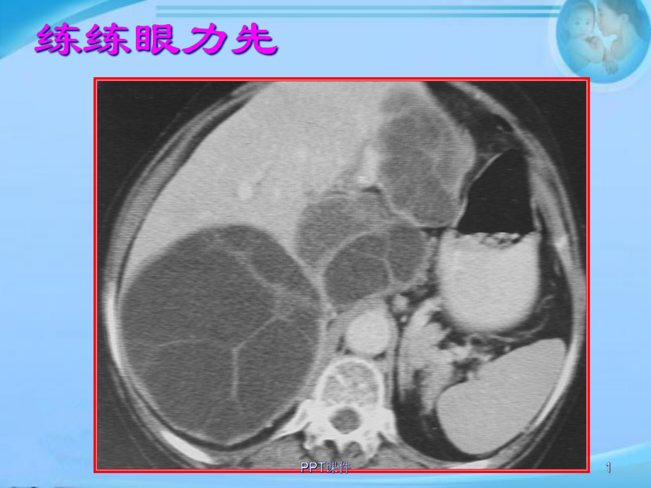 肝包虫病-课件.ppt_第1页