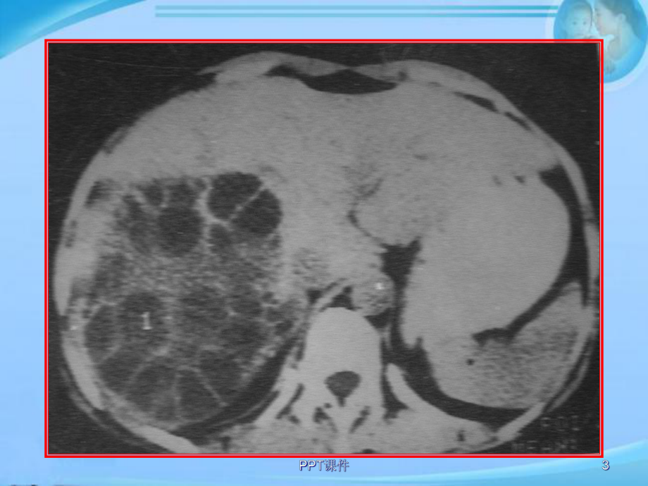 肝包虫病-课件.ppt_第3页