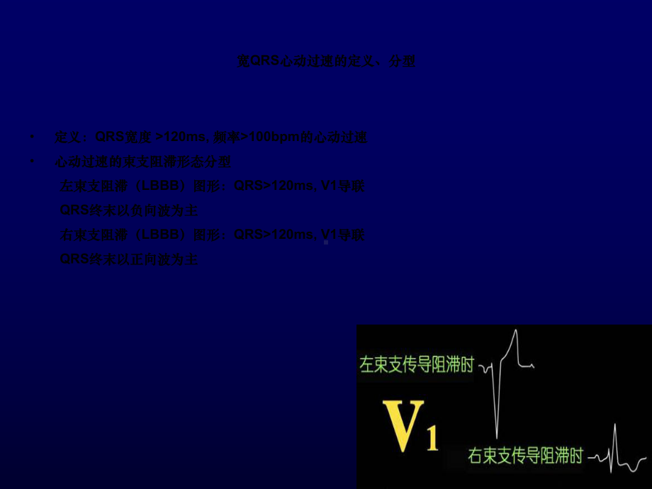 宽qrs心动过速鉴别诊断-单兆亮课件.ppt_第2页