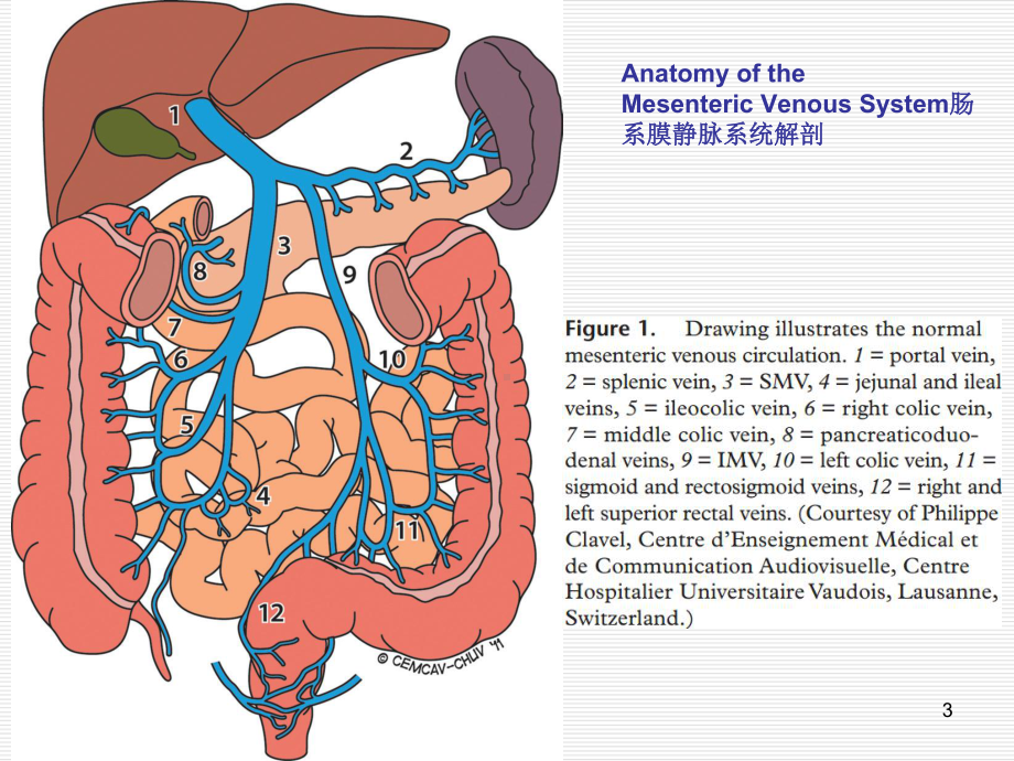 肠系膜静脉血栓(MVT)的CT表现医学课件.ppt_第3页