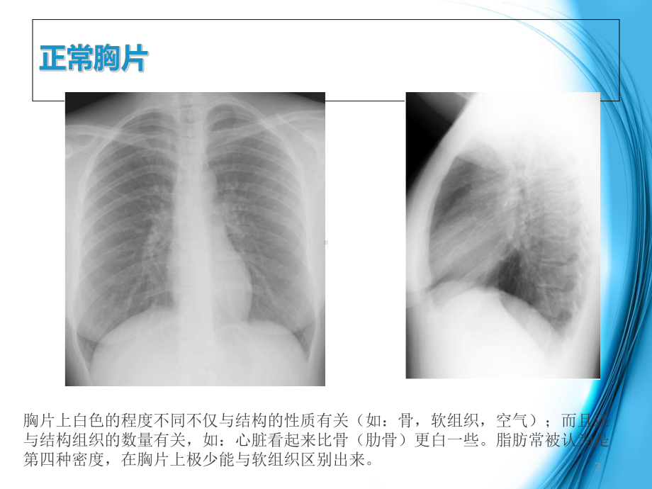 胸片入门及常见胸片的解读课件.ppt_第3页