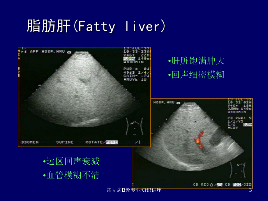 常见病B超专业知识讲座培训课件.ppt_第3页