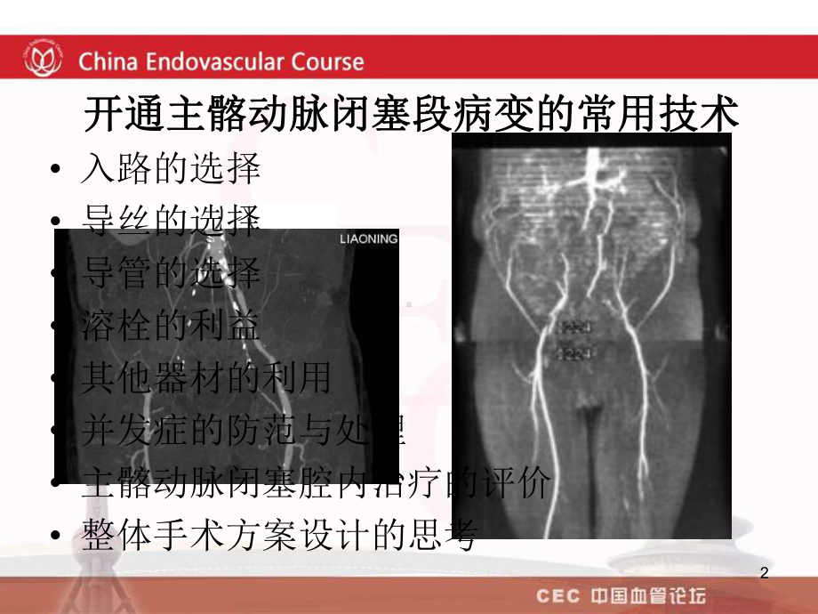 开通主髂动脉闭塞段病变的常用技术吴丹明课件.ppt_第2页