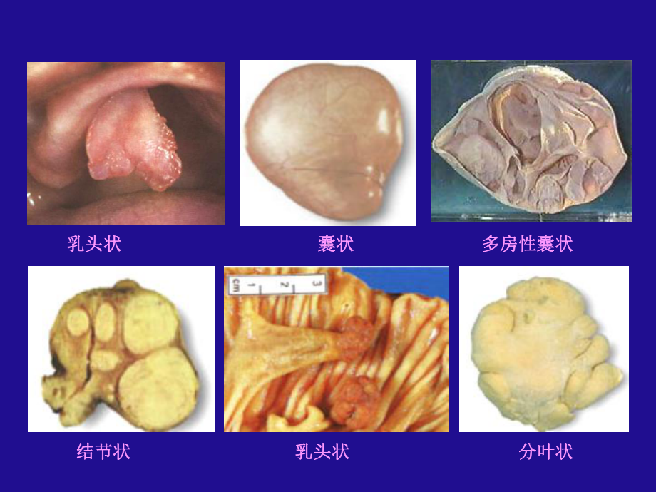 （北京大学）《病理学》-第五章 肿瘤.ppt_第2页