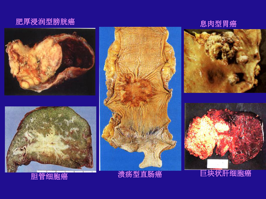 （北京大学）《病理学》-第五章 肿瘤.ppt_第3页