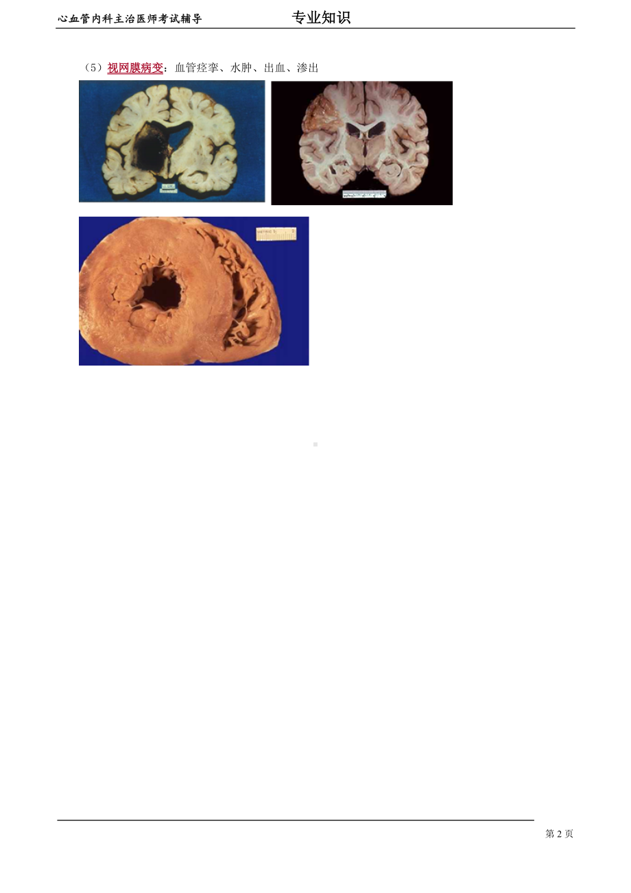 心血管内科主治医师资格笔试专业知识考点解析(5)：高血压病.doc_第2页