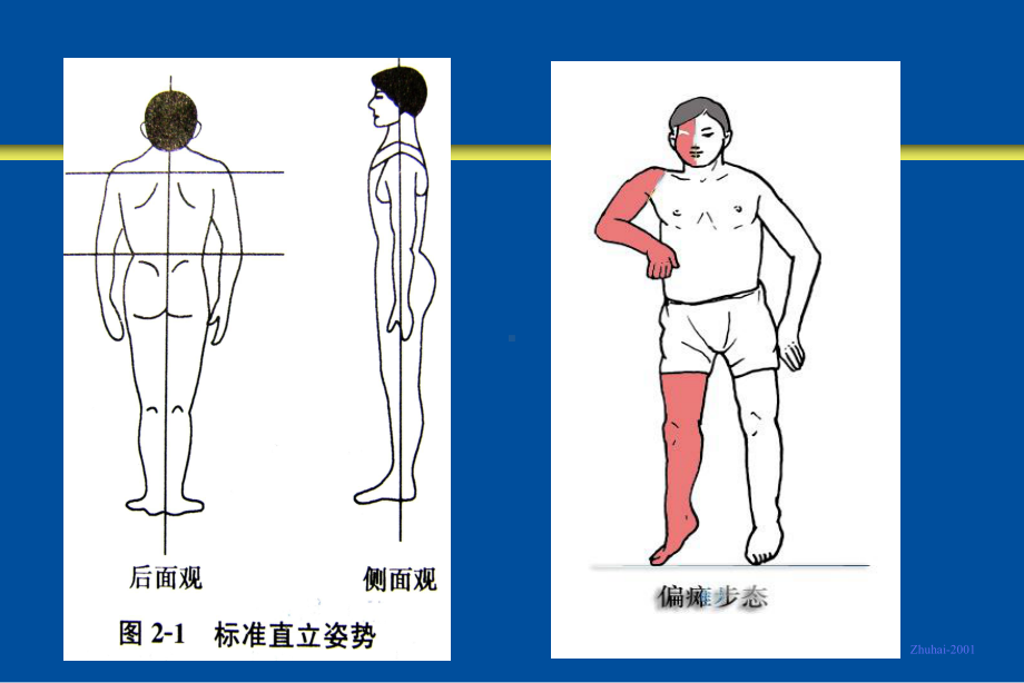 偏瘫家庭康复.ppt_第2页