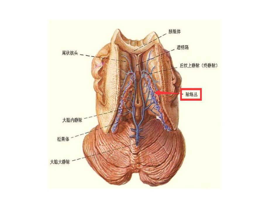 脉络丛肿瘤-课件.ppt（31页）_第3页