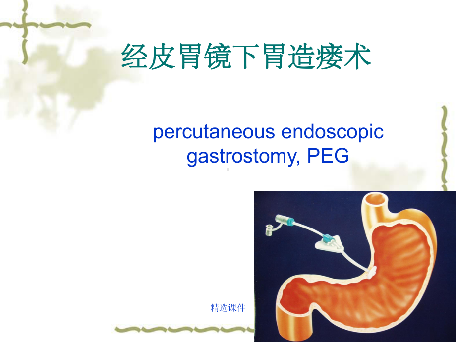 经皮胃镜下胃造瘘课件_002.ppt（51页）_第1页