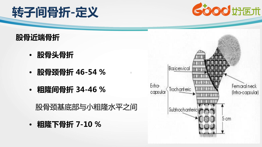 转子间骨折(ppt课件).pptx_第2页