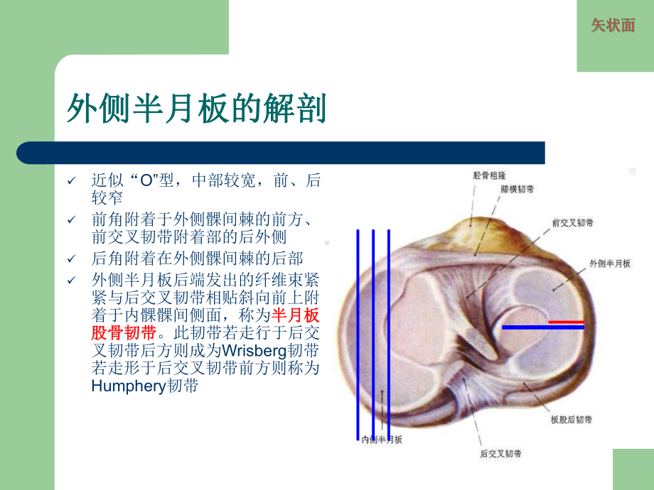 膝关节半月板损伤MRI诊断(ppt)（课件）.ppt_第3页