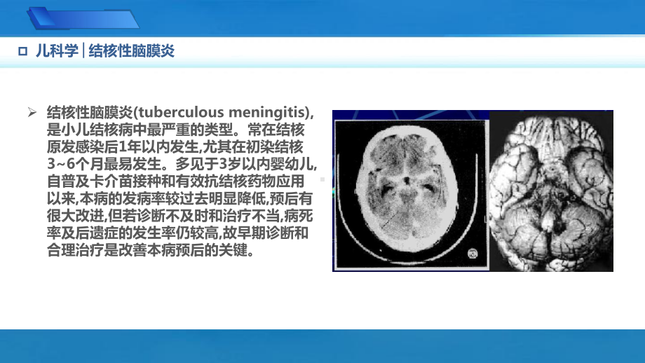 9.3.4结核性脑膜炎儿科学人卫版第10版教材PPT课件下载龙殿法第十版.pptx_第2页