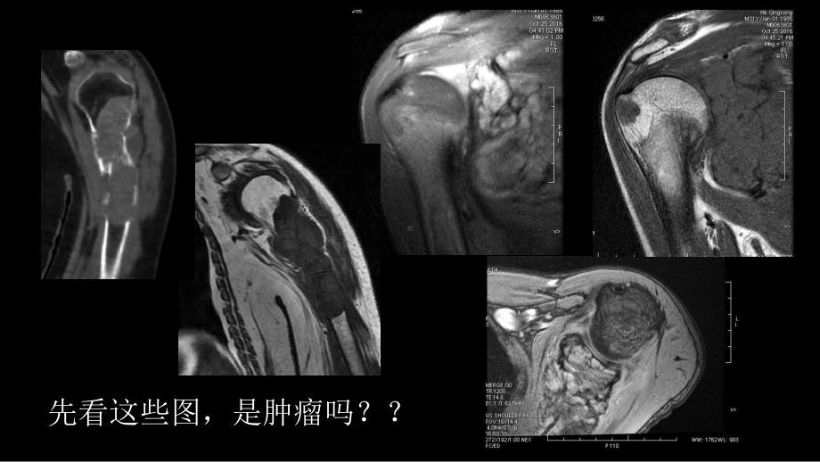 影像诊断学习与扩展：代谢性骨病(病例23) ppt课件-人卫版《影像与诊断》.pptx_第3页