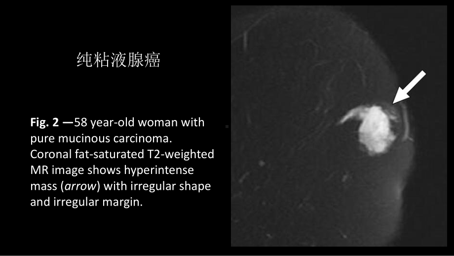 乳腺粘液腺癌MR与病理特点 ppt课件-人卫版《影像与诊断》.pptx_第3页